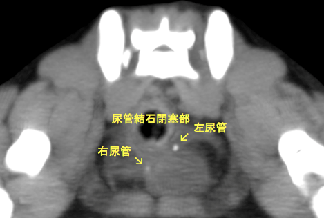 CT検査所見